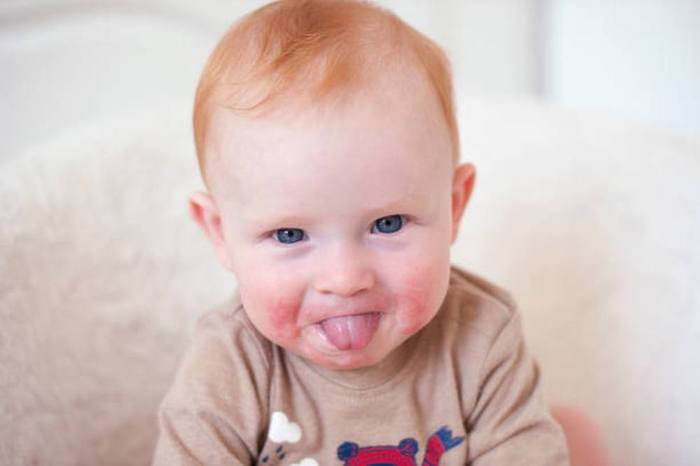 teething baby with rash around mouth from drooling